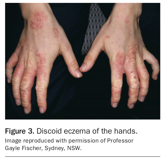 Discoid eczema more than just dermatitis Medicine Today